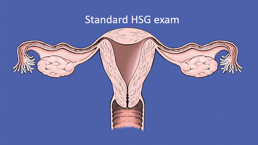 Exam with bilateral tubal patency